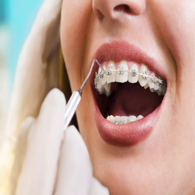 braces