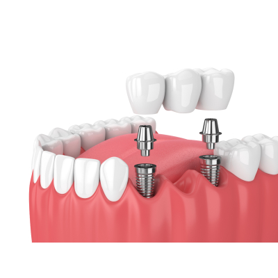 dental-implants